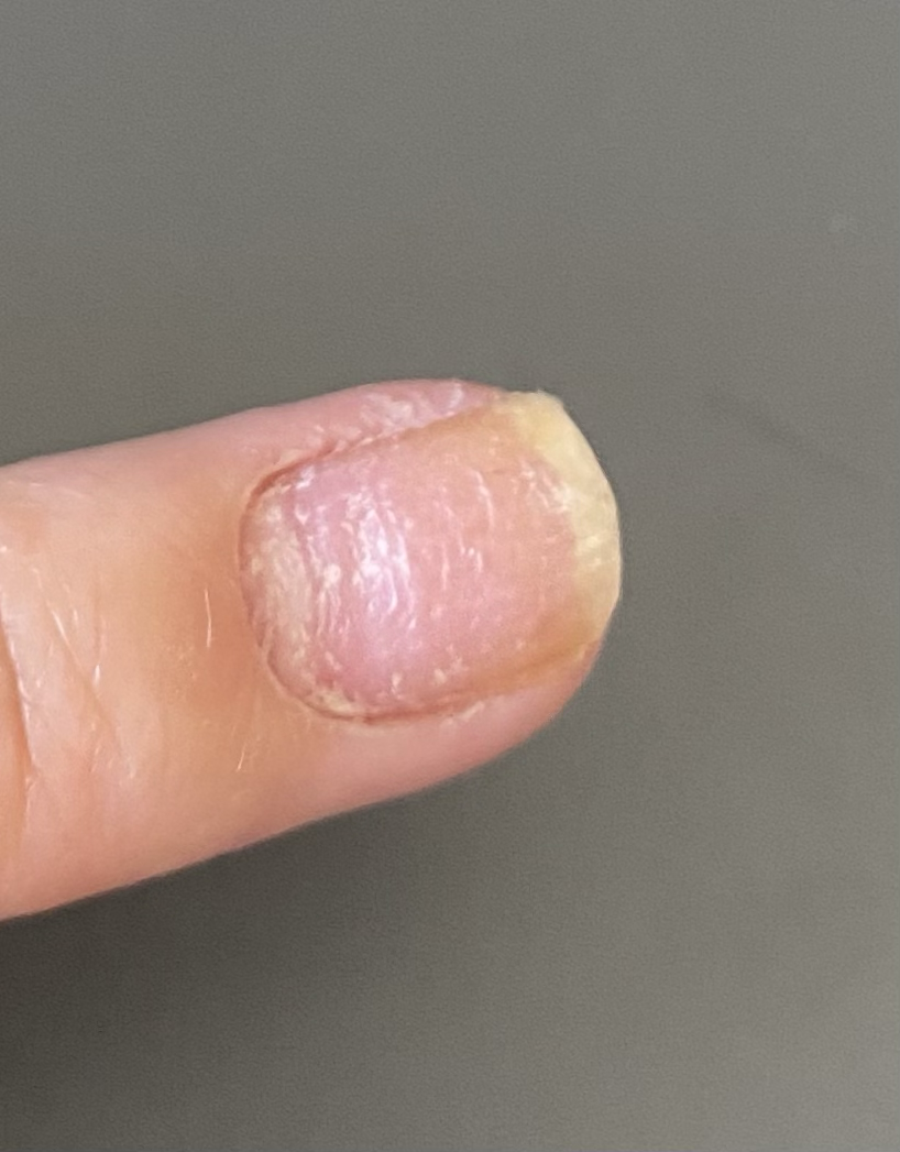 指甲上凹凸不平,横向上一条条的,是缺钙吗? - 知乎