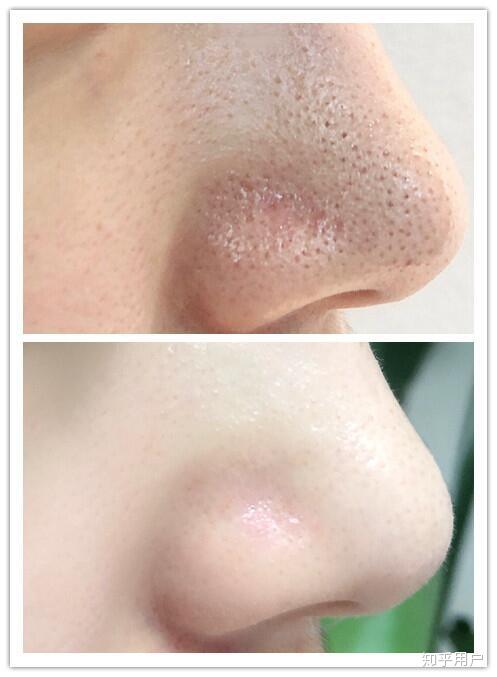 黑头和白头有什么区别