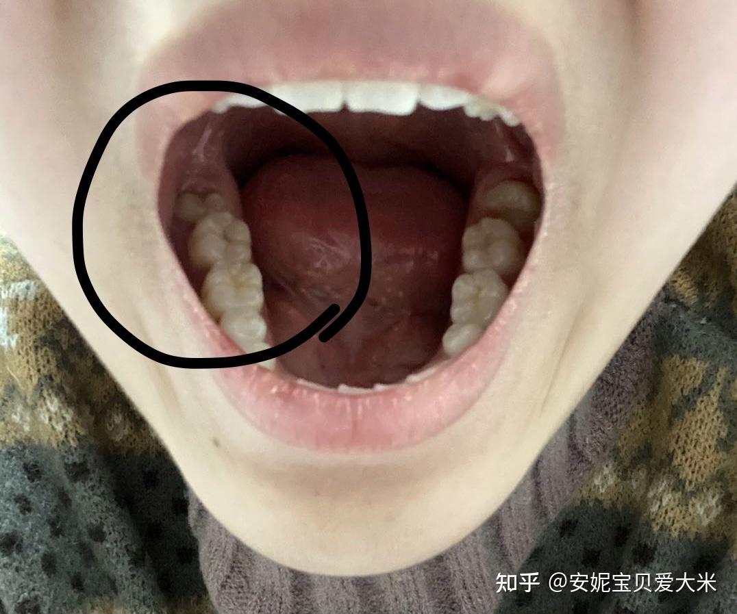 智齿长在牙龈外侧图片