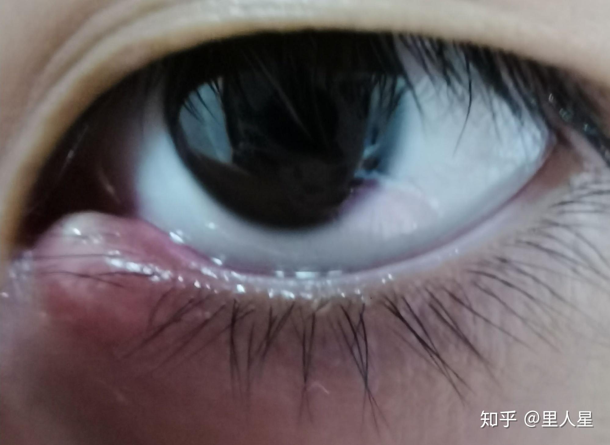 有没有得过外麦粒肿的朋友,怎么个痊愈过程? - 知乎
