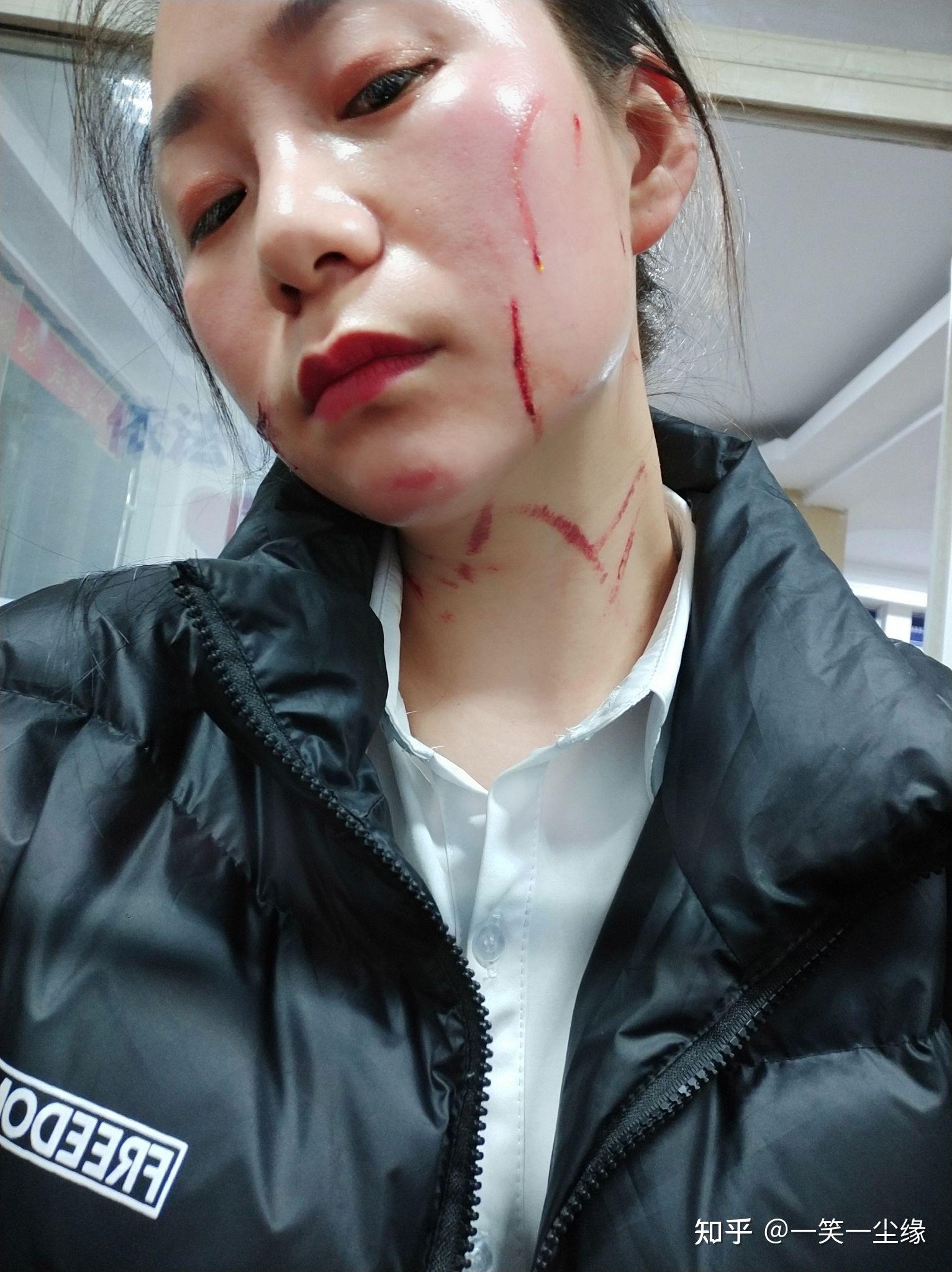 脸上被人抓了 刮掉几块肉 怎么处理才能快速痊愈且不留疤痕? - 知乎