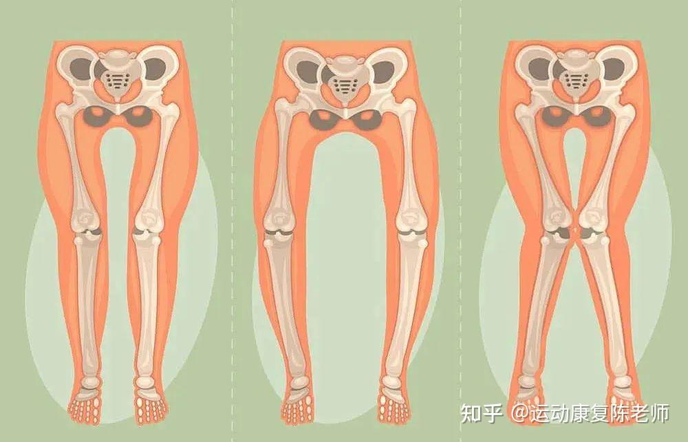 【锐博康复科普】科学解读下肢力线:如何改善X型腿和O型腿? - 知乎