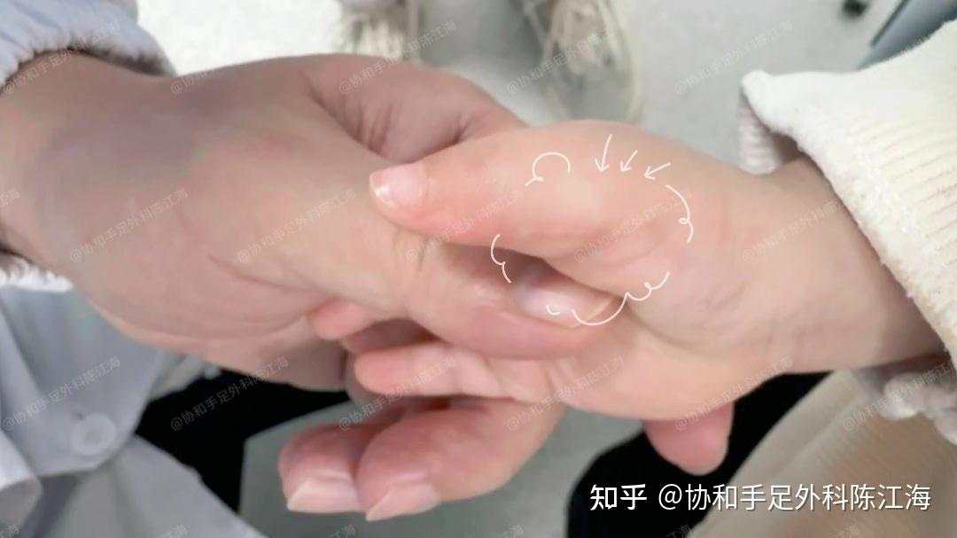 为什么六指孩子聪明