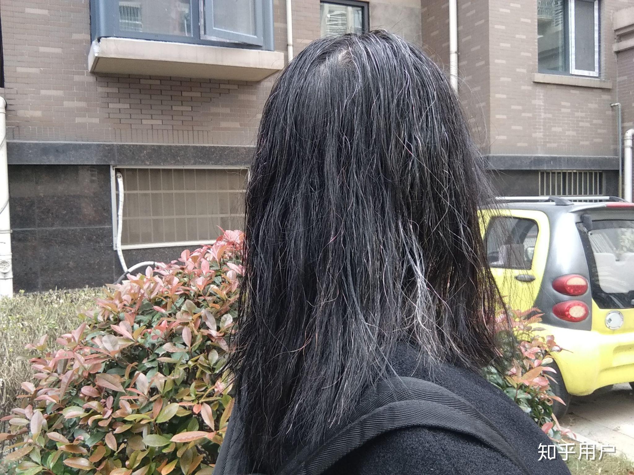 少年白青少年长白发怎么办