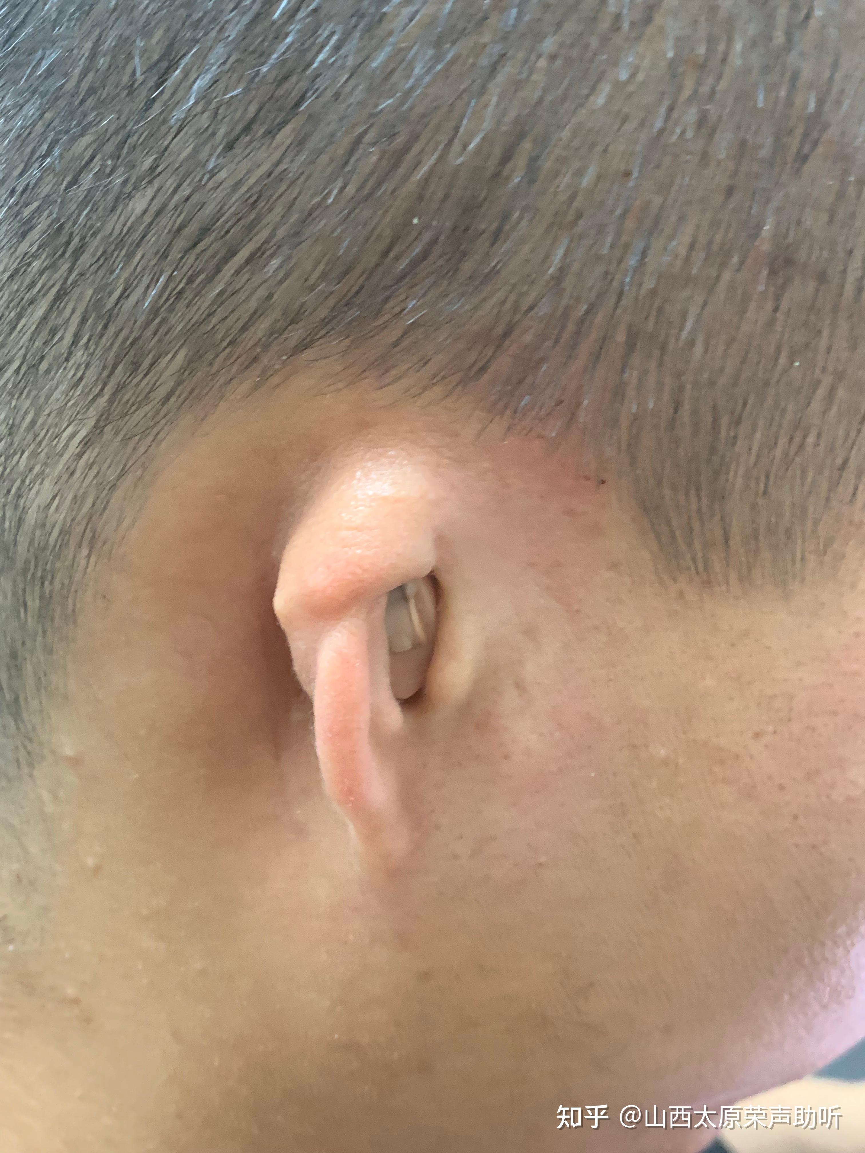 小耳畸形对听力有哪些影响?