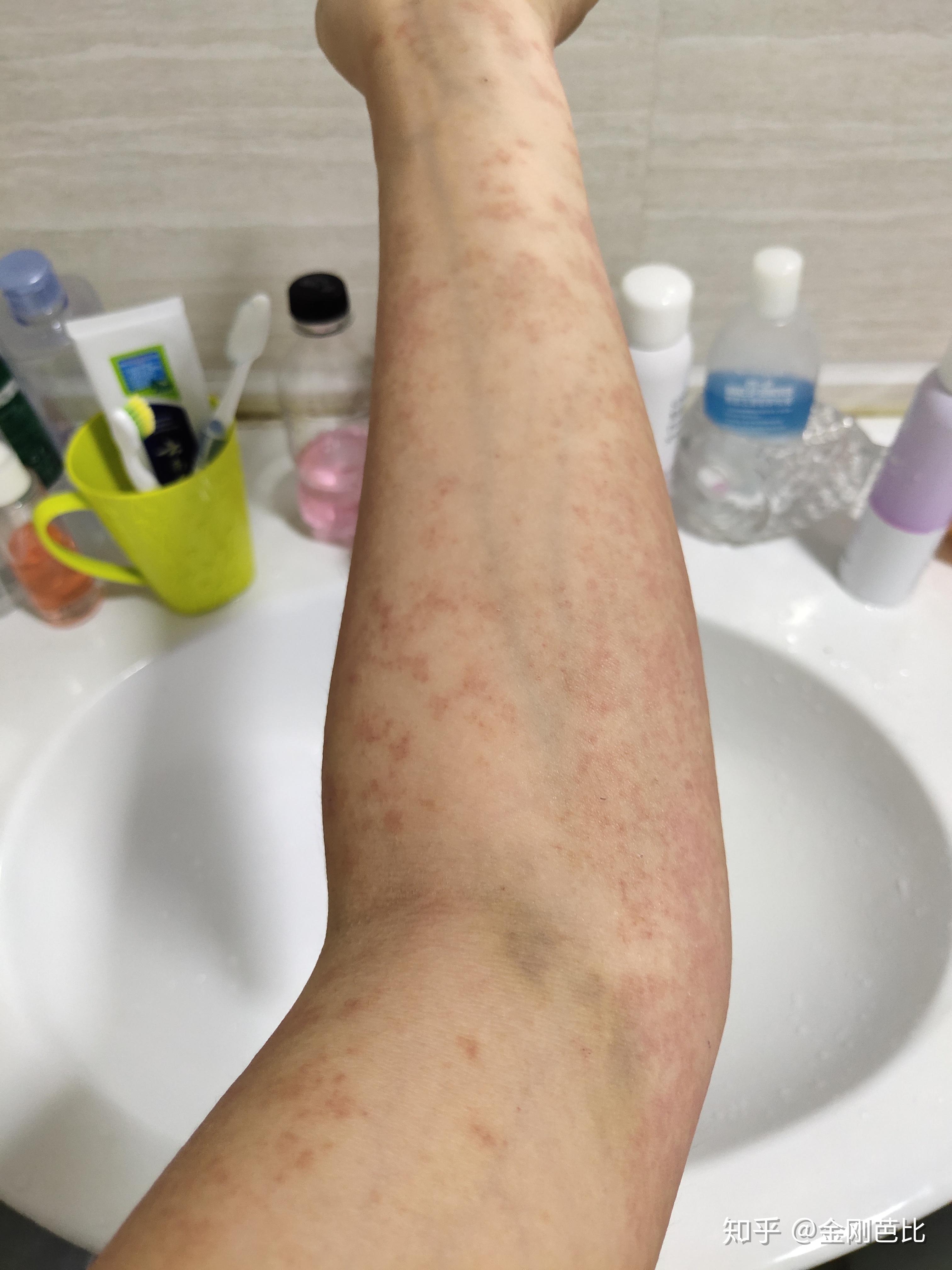 得了多形性红斑,怎么才能痊愈啊?要忌什么吗? - 知乎