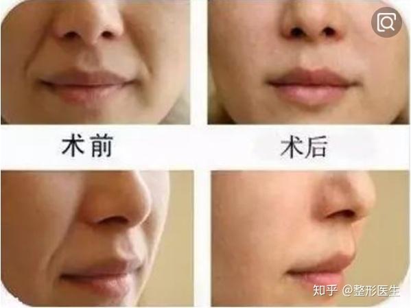 为什么笑起来鼻子两边会有这种纹路?不是法令纹? - 知乎