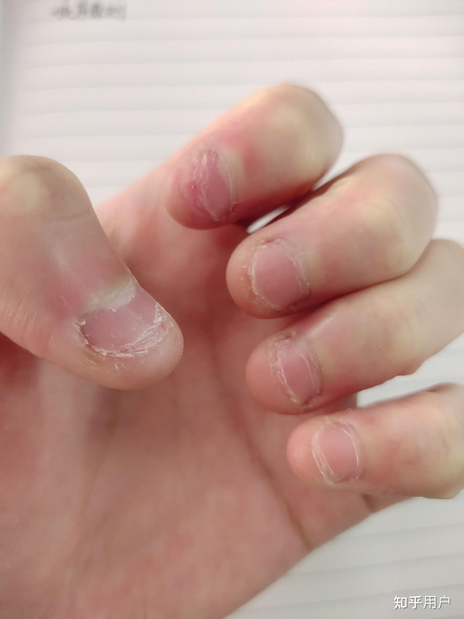 成年人依然有啃手指甲的行为,如何戒掉?