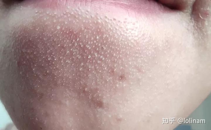 我的黑头粉刺好多密集勿进怎么办