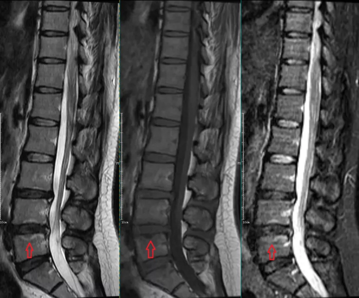 椎体终板炎 | 发生机制、分型以及 MRI 表现 - 知乎