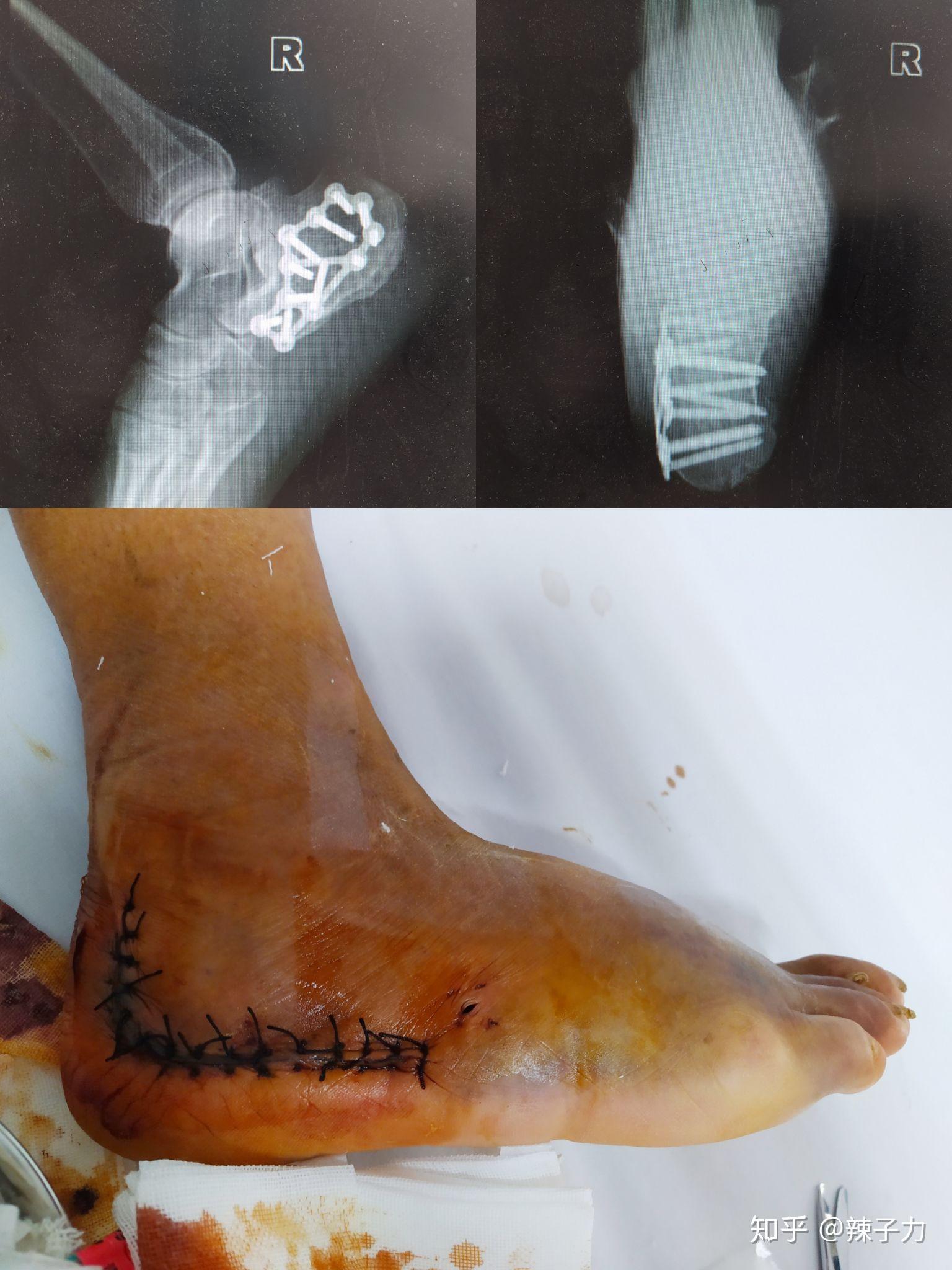男朋友右跟骨粉碎性骨折,一年了走路还是痛,医生说追踪治疗,到底是