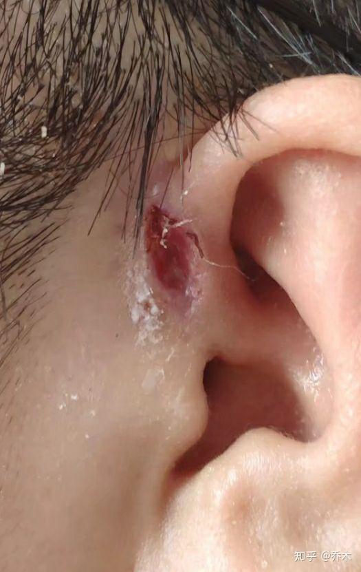 耳朵上隔壁有个小洞,是天生就会这样的,那个小洞有时还会流水出来