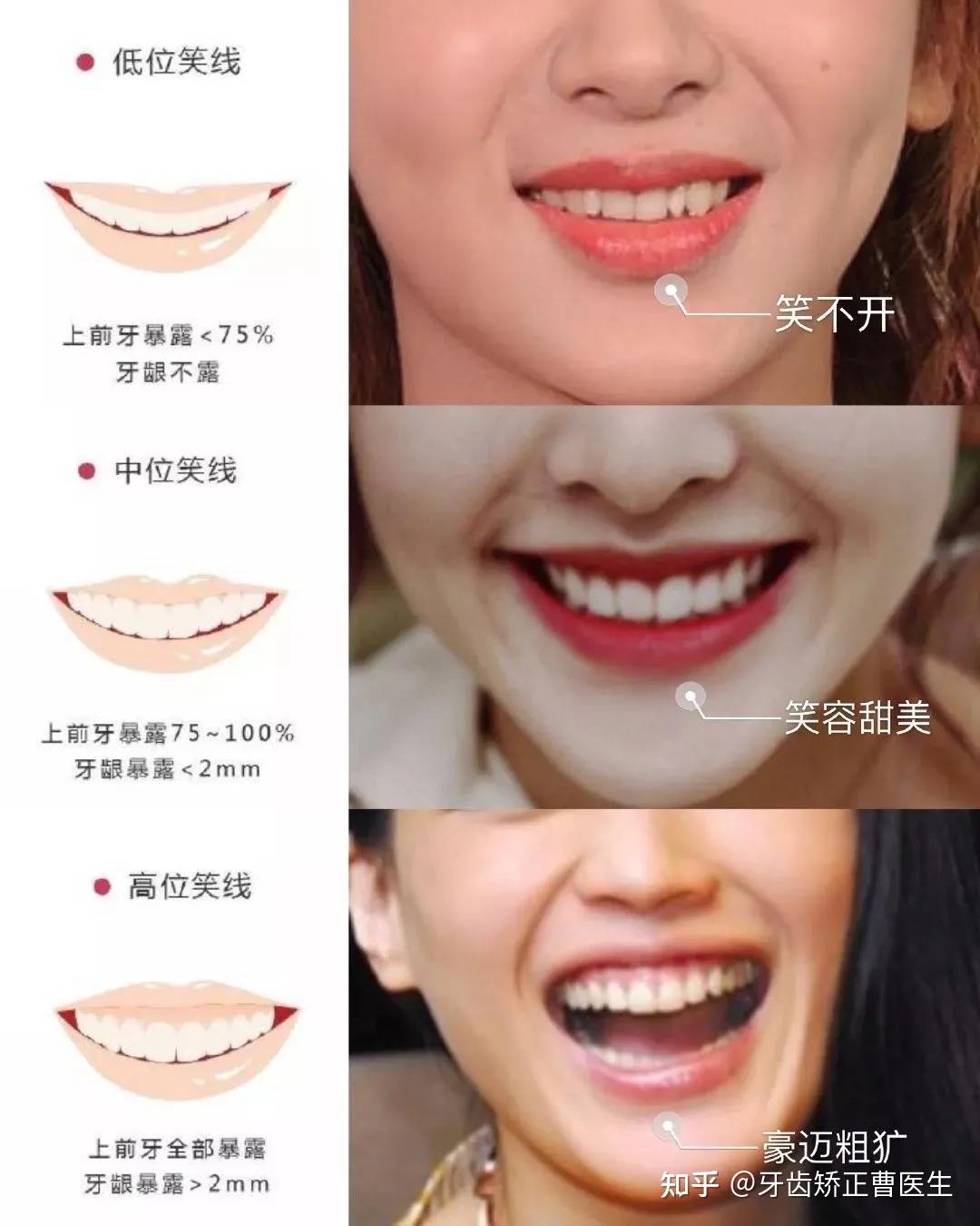 什么是微笑线？ - 知乎