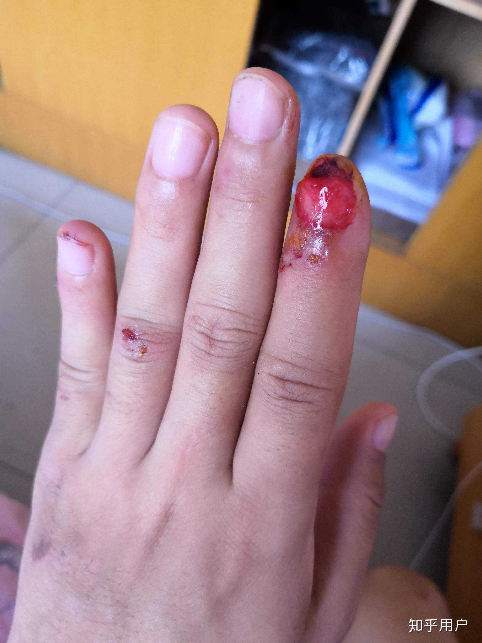 指甲被连根拔起是什么体验?