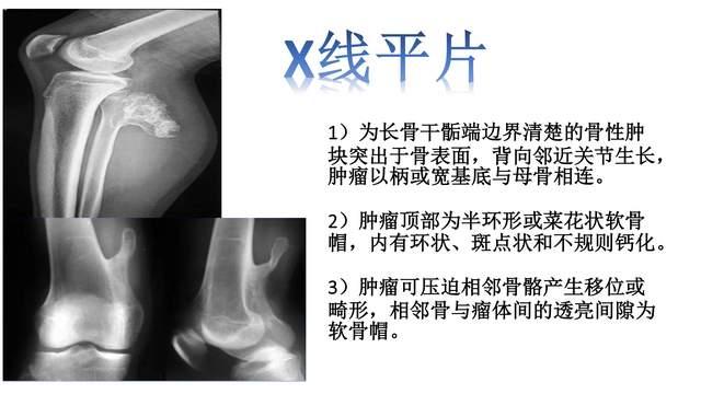 骨肉瘤影像图怎么看