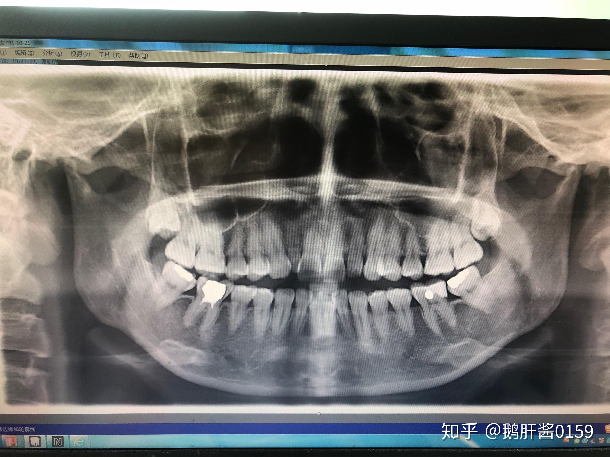 髁突基本吸收没了,有必要做正畸正颌么,为什么关节科医生不太建议做