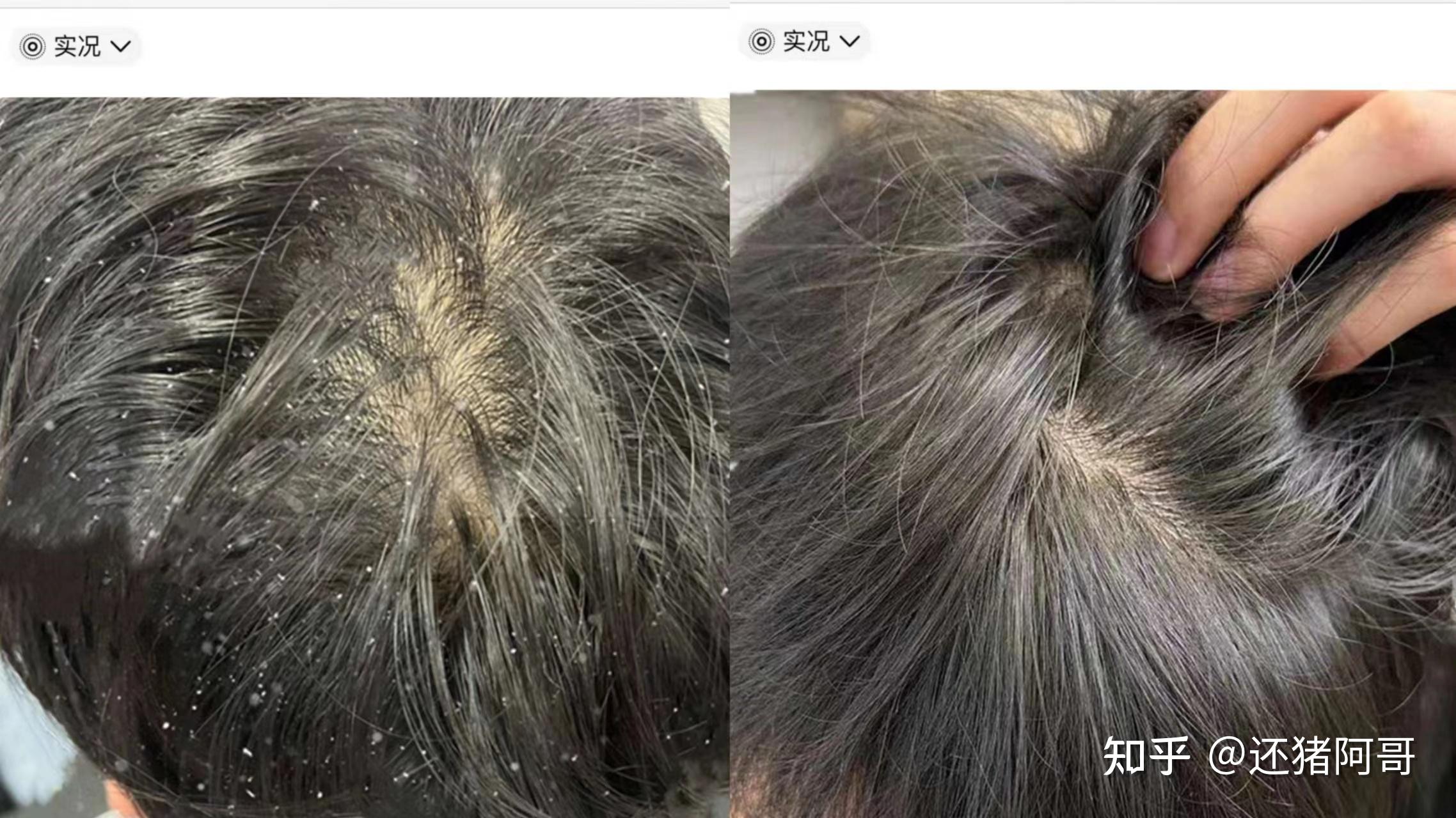 头皮挠出白色油腻物图片