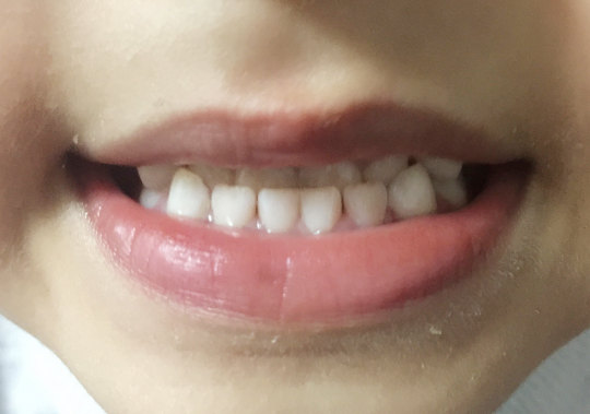 牙齿矫正造成地包天的是什么原因