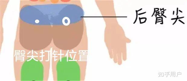 臀中肌肌肉注射定位图片