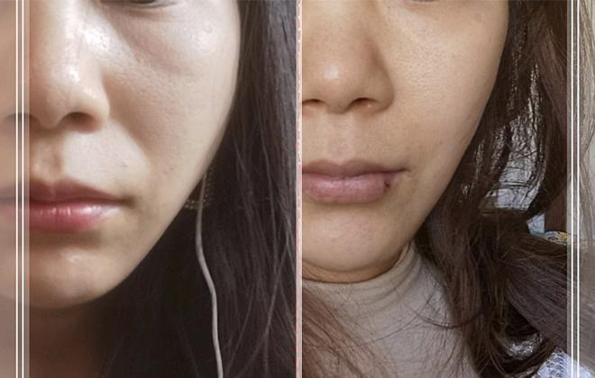 印第安纹剥离有风险吗这种方式轻松零痛苦