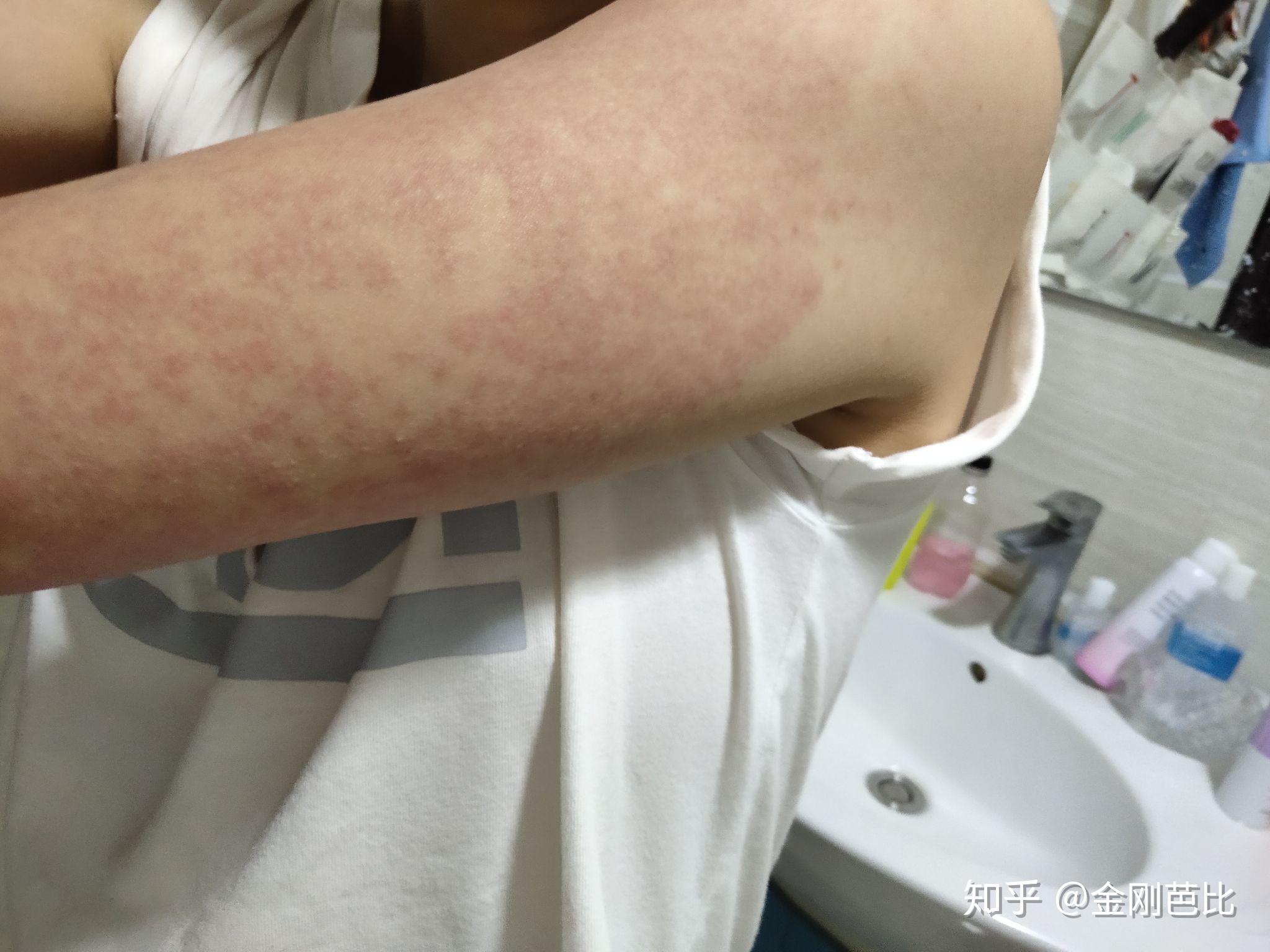 得了多形性红斑,怎么才能痊愈啊?要忌什么吗? - 知乎