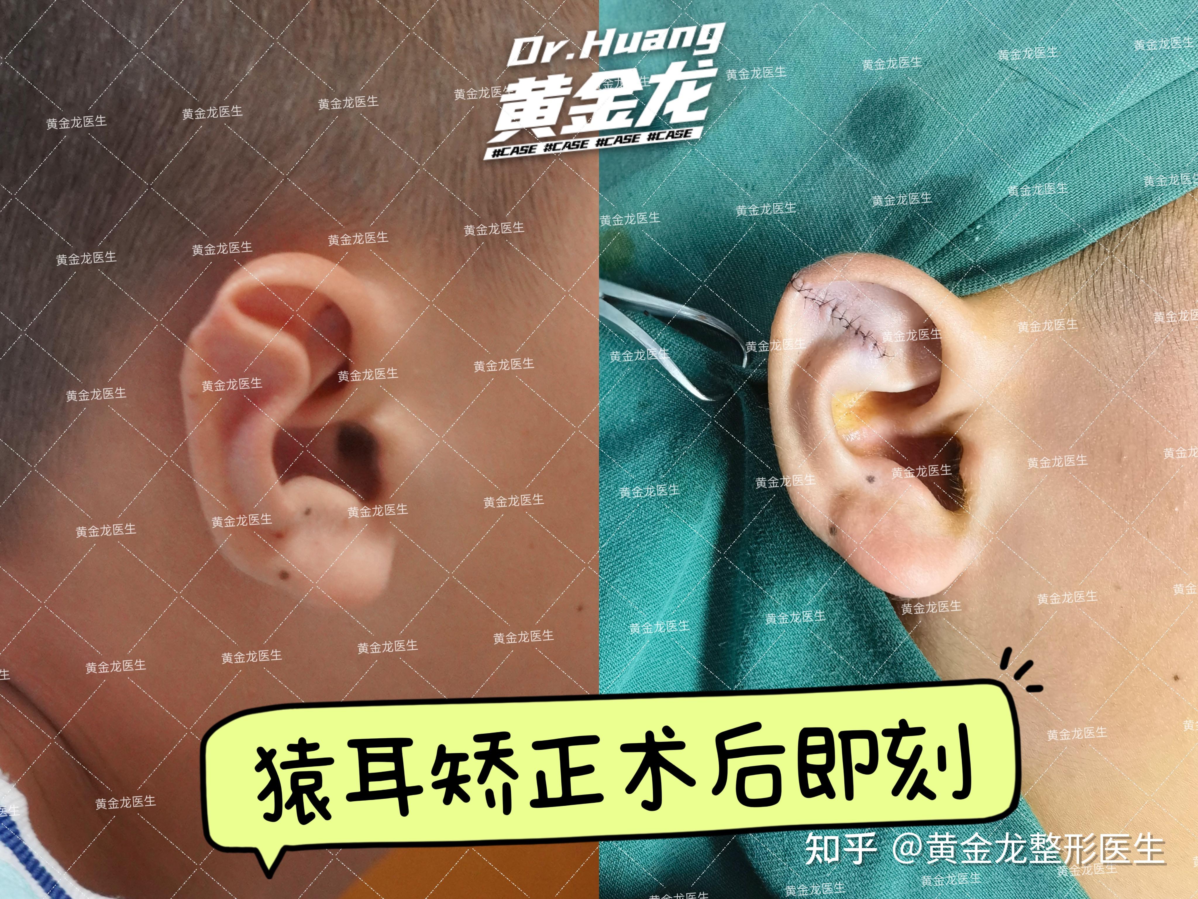 耳朵轮廓不明显=手术失败？讲讲小耳畸形矫正术二期的恢复 - 哔哩哔哩