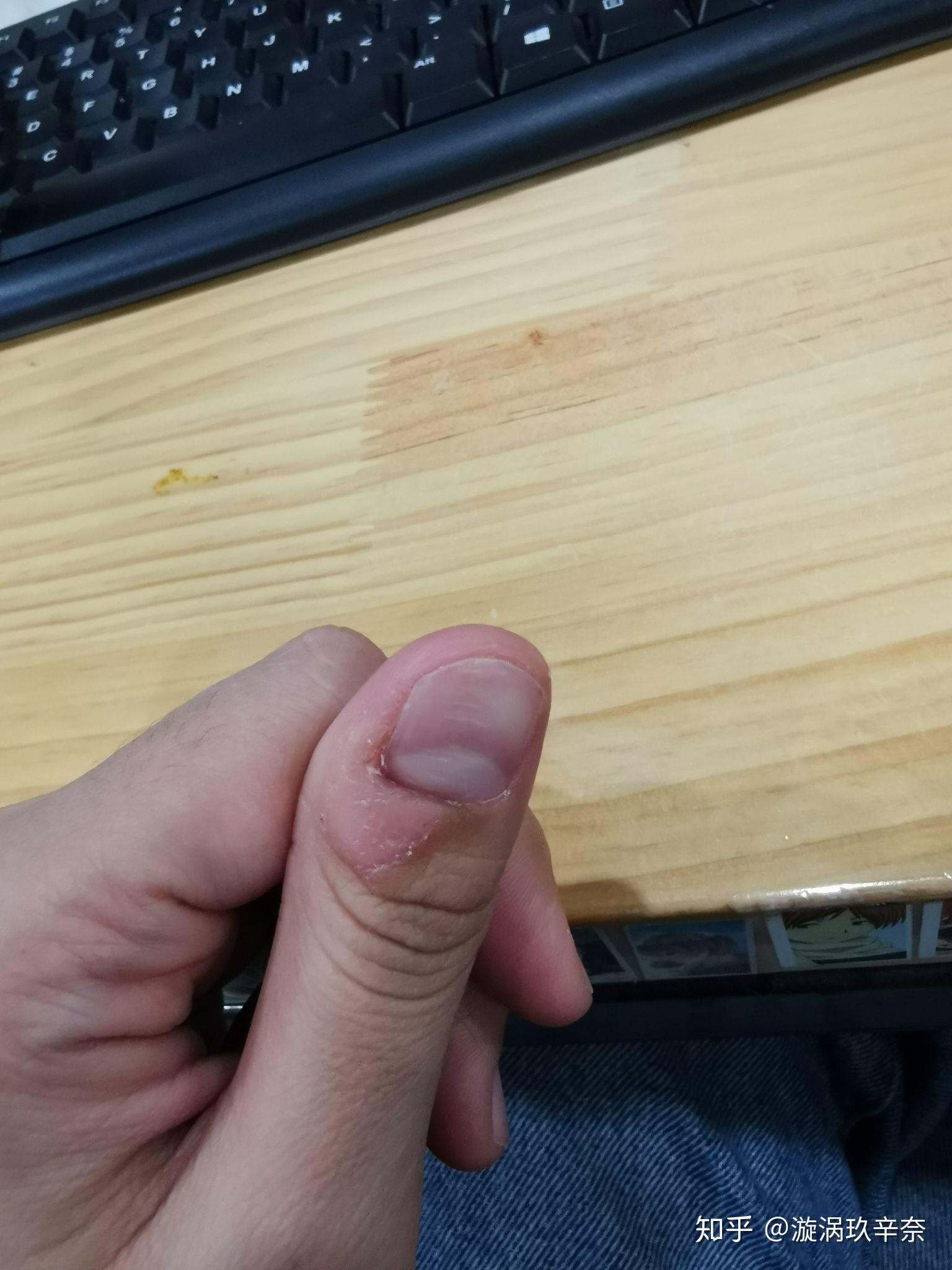 克制不住的抠手指头是心理问题吗? - 知乎