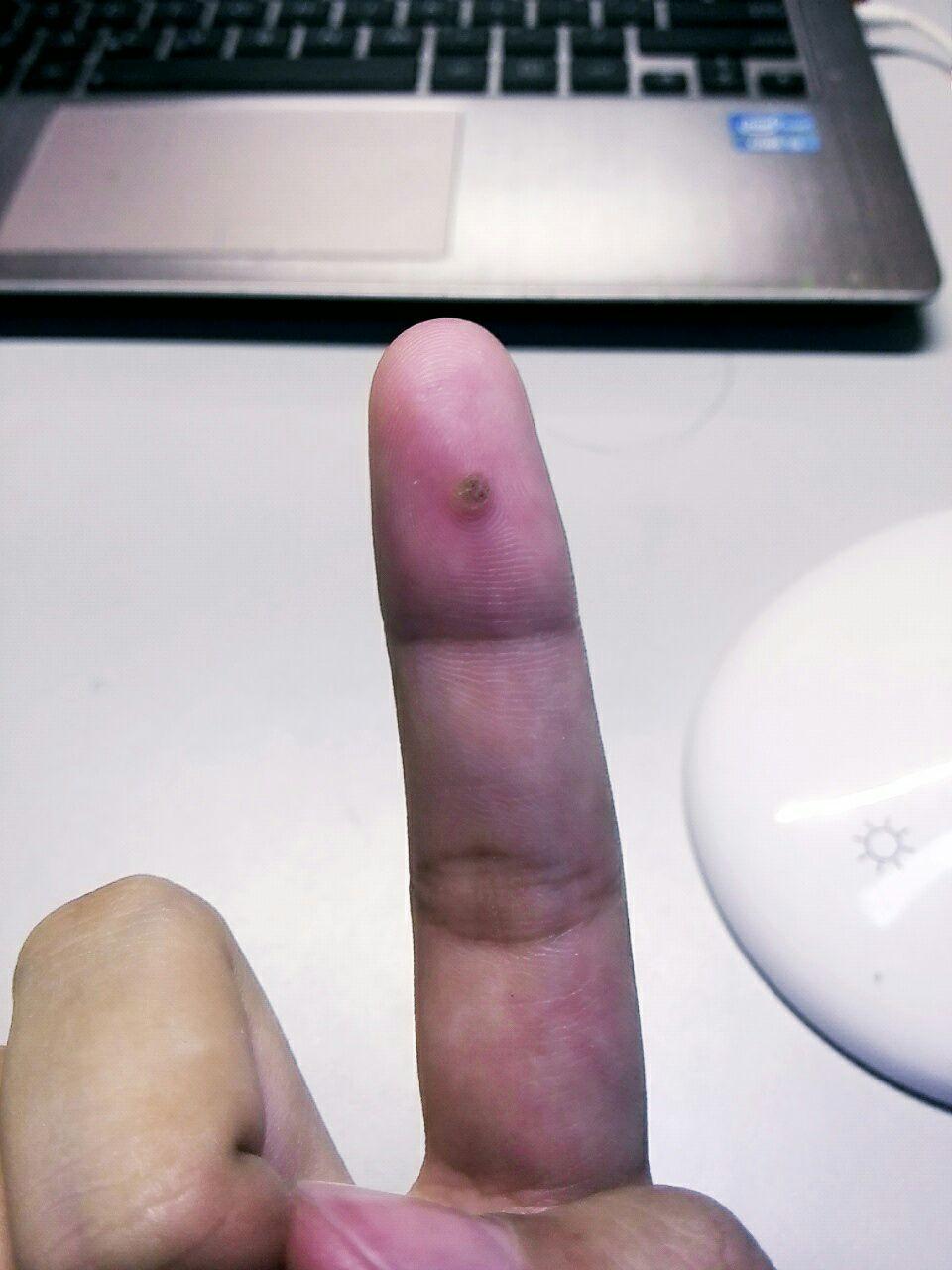 治疗手指上的寻常疣(鱼鳞痣)有什么办法,或者药物? - 知乎