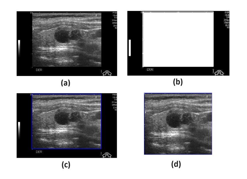 医学影像/Breast Ultrasound