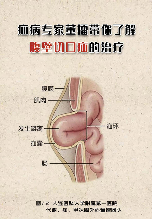 疝病專家董擂帶你瞭解腹壁切口疝的治療