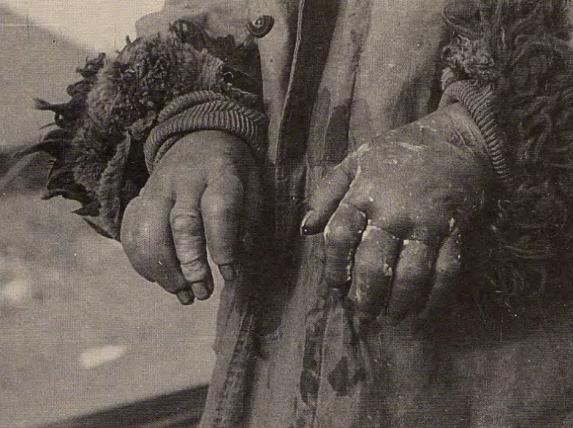 冻伤 24 小时后的手指