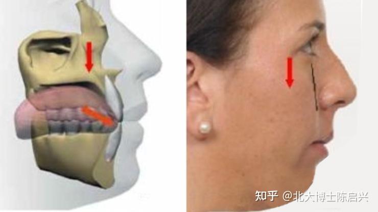 【口呼吸】唇舌肌训练,在家也能做 - 知乎