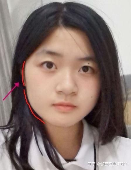 对于颧骨外扩怎么看. - 知乎