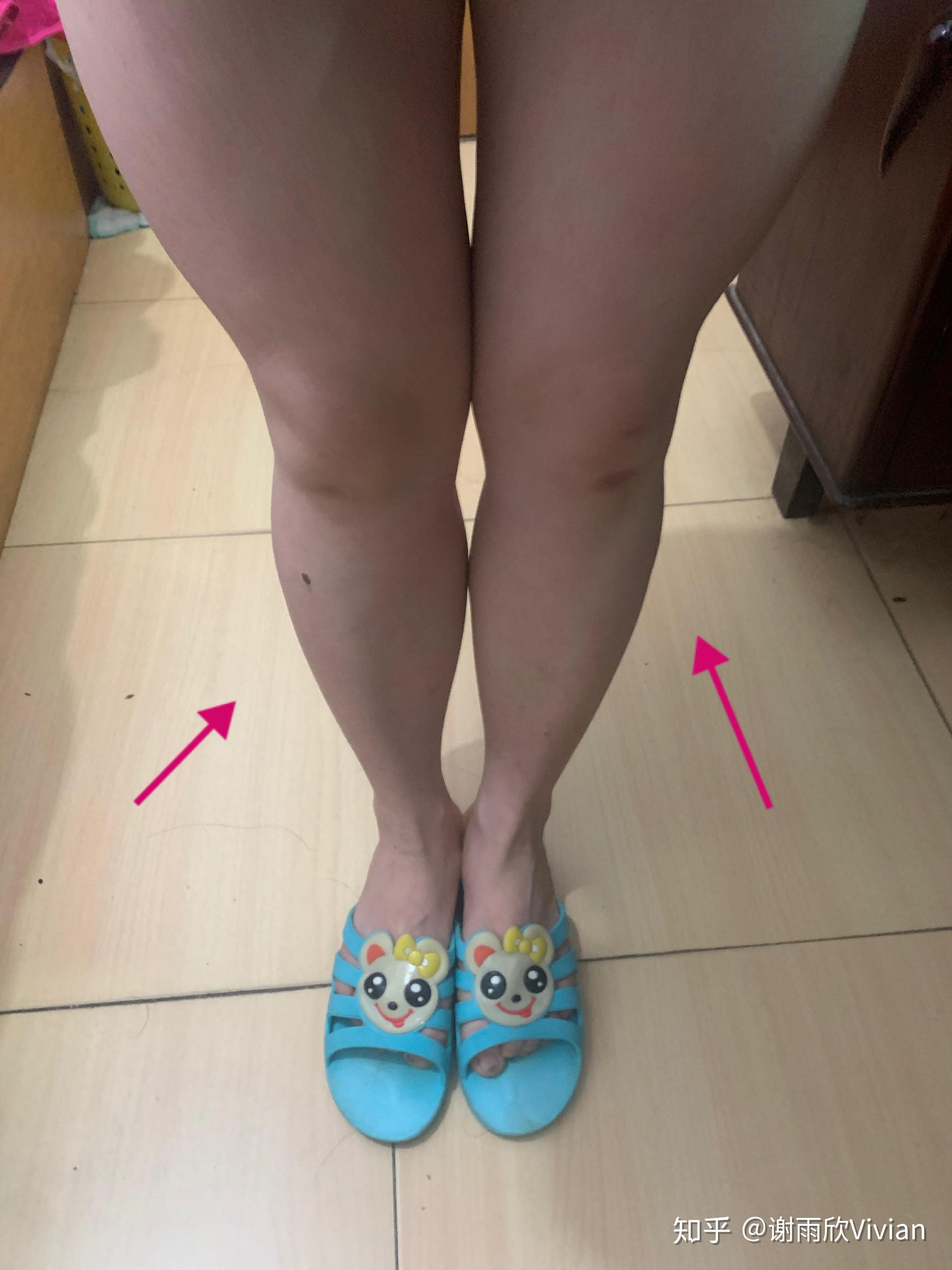 大脚趾中断下侧和脚后跟疼-乳腺癌康复圈--觅健