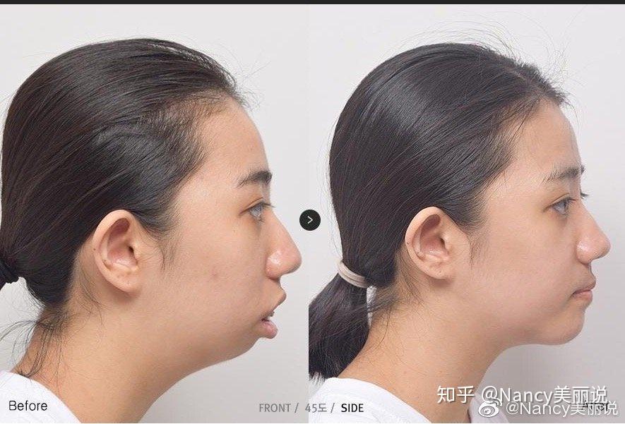 上嘴唇外突上翘该如何矫正