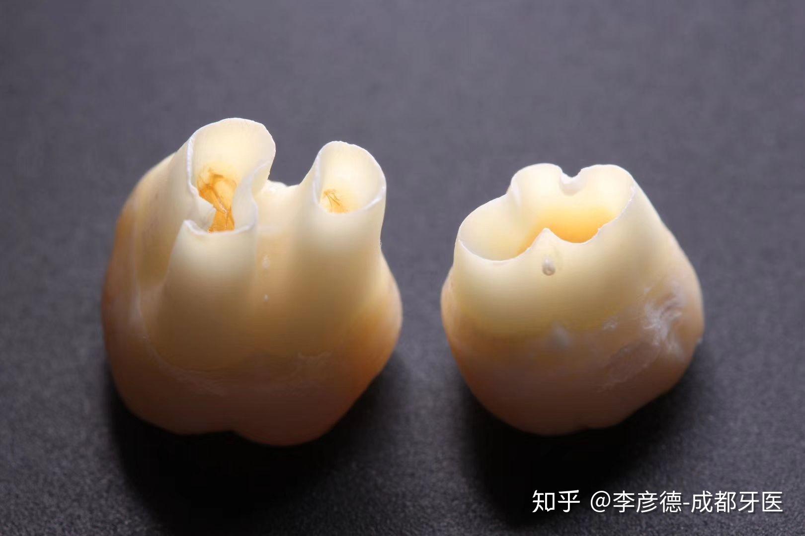 根尖孔未完全形成是什么样的