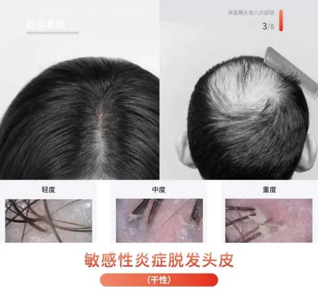 头皮紧绷、长小疙瘩、发痒、头屑......到底应该怎么办？ - 知乎