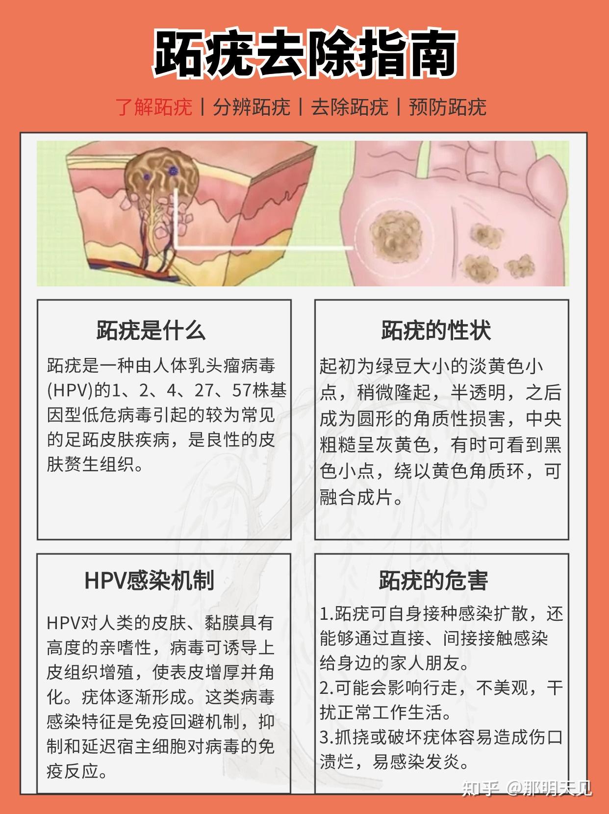 跖疣传染吗怎么分辨鸡眼和跖疣有什么方法