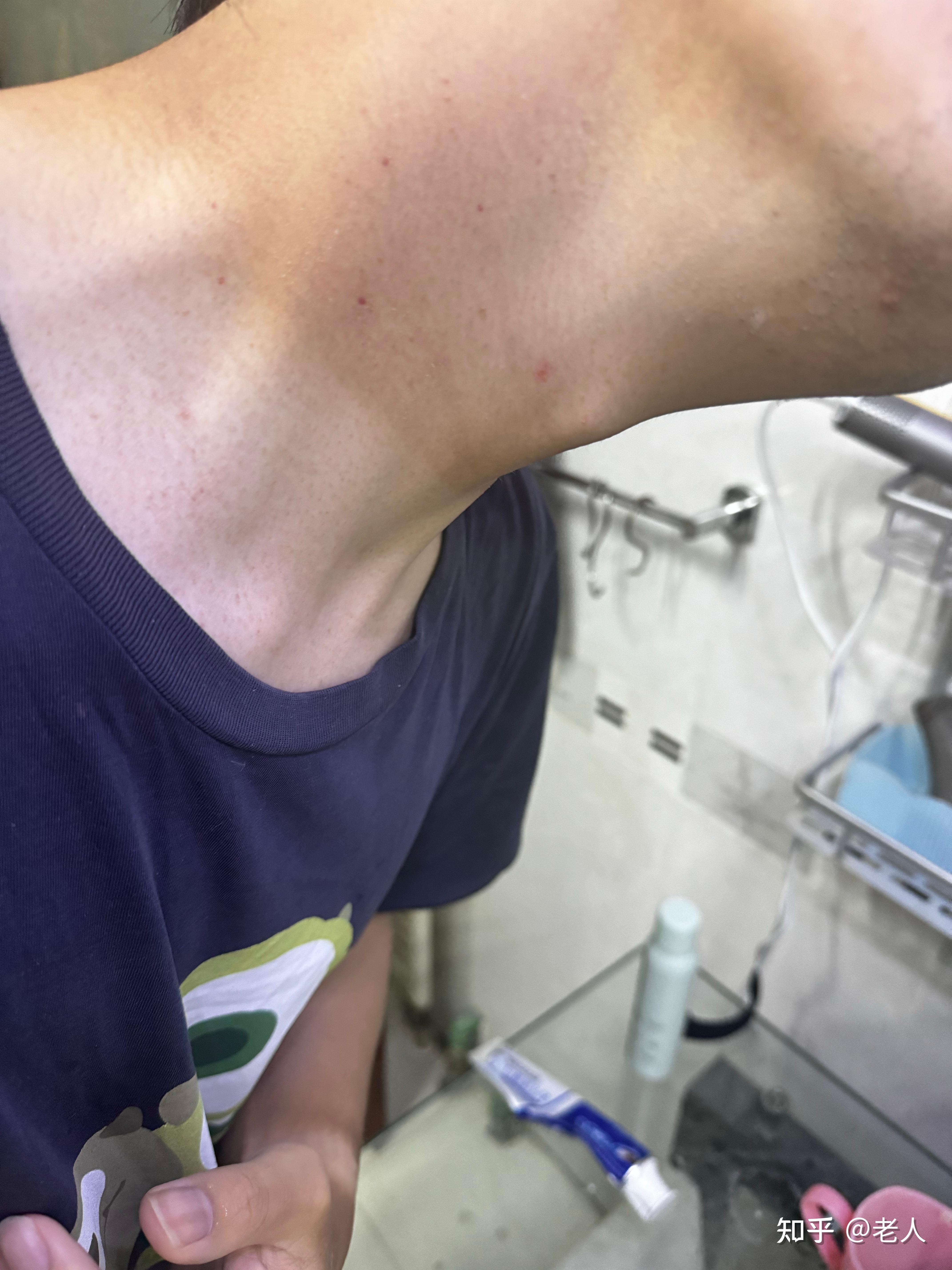 感染艾滋病有什么症状啊?