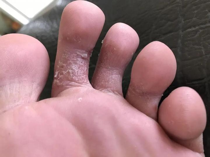 脚气烂脚趾缝痒溃烂怎么治用什么药效果好
