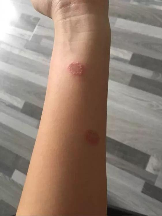 人长时间长猫藓怎么办