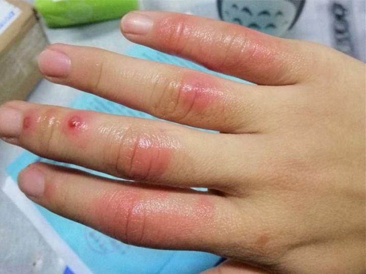 冬天冻手冻脚怎么办