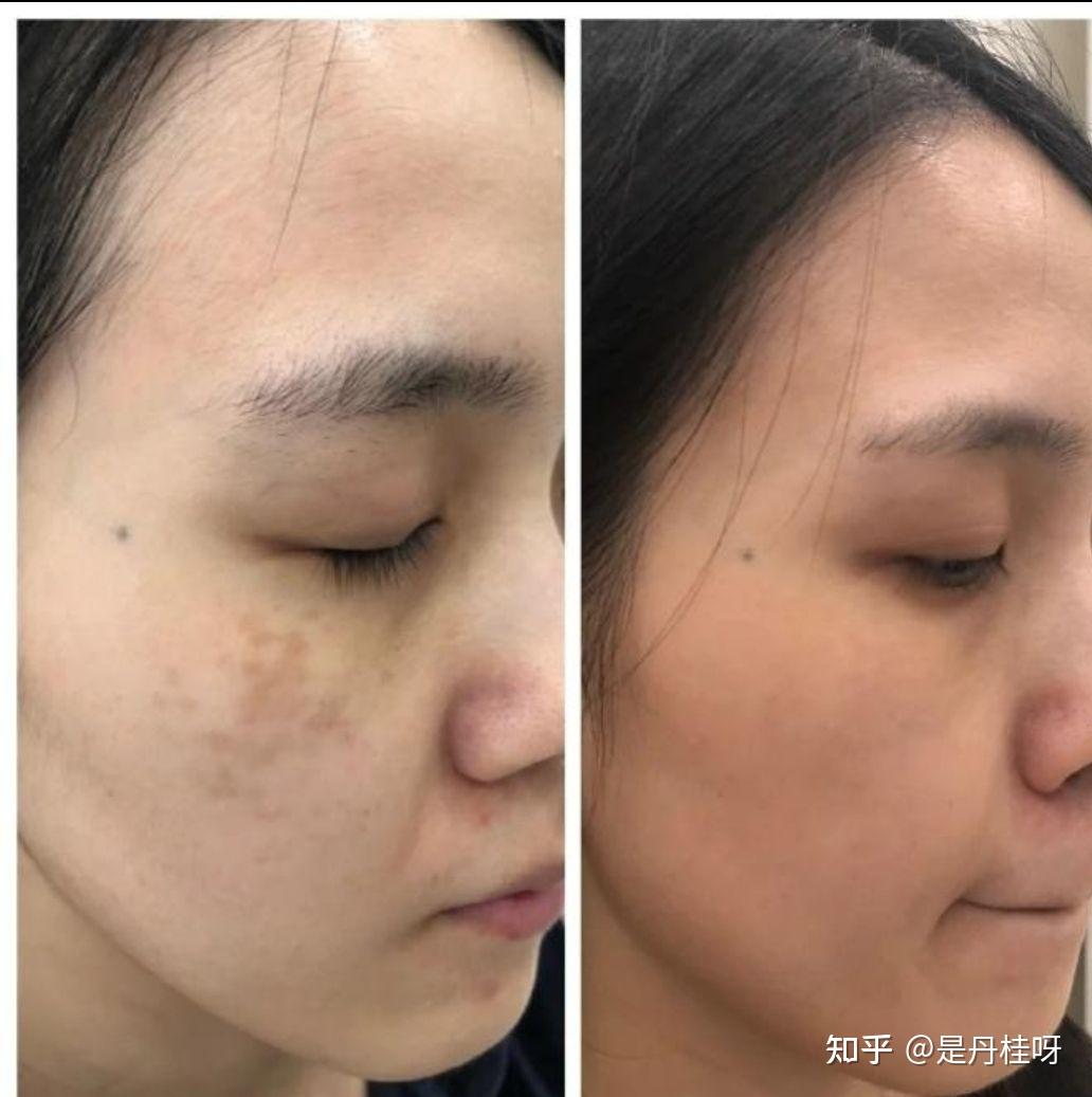 20岁左右的女生眼睛周围长斑什么原因啊