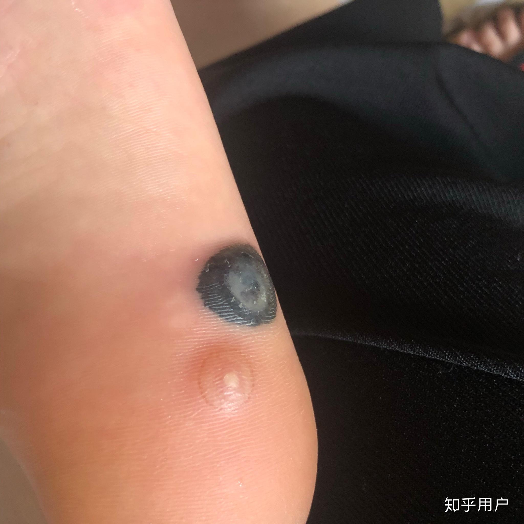 脚上长病毒疣怎么治