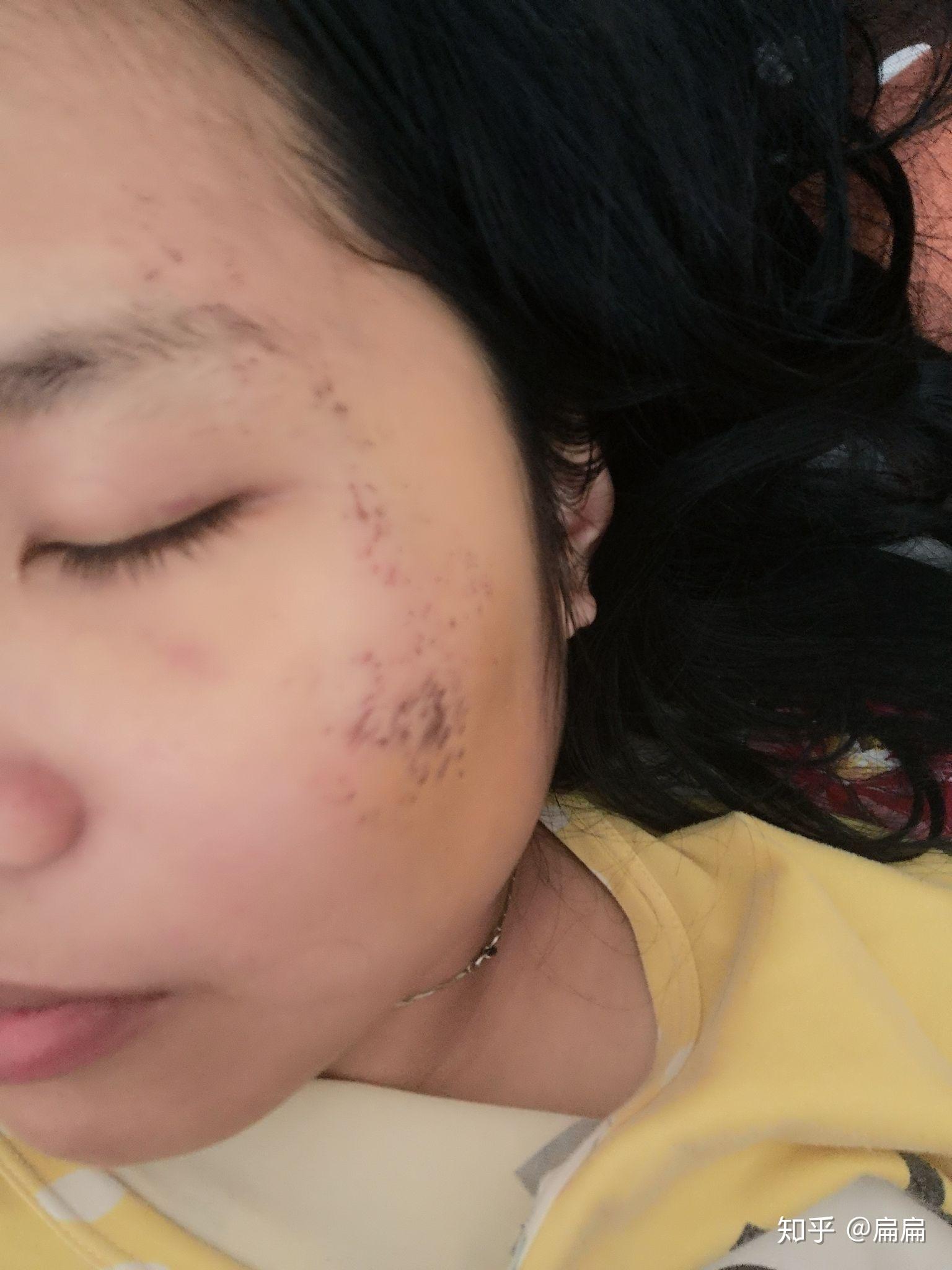 脸部擦伤结痂已经掉了.但是红黑的一片,怎样才能避免留疤? - 知乎