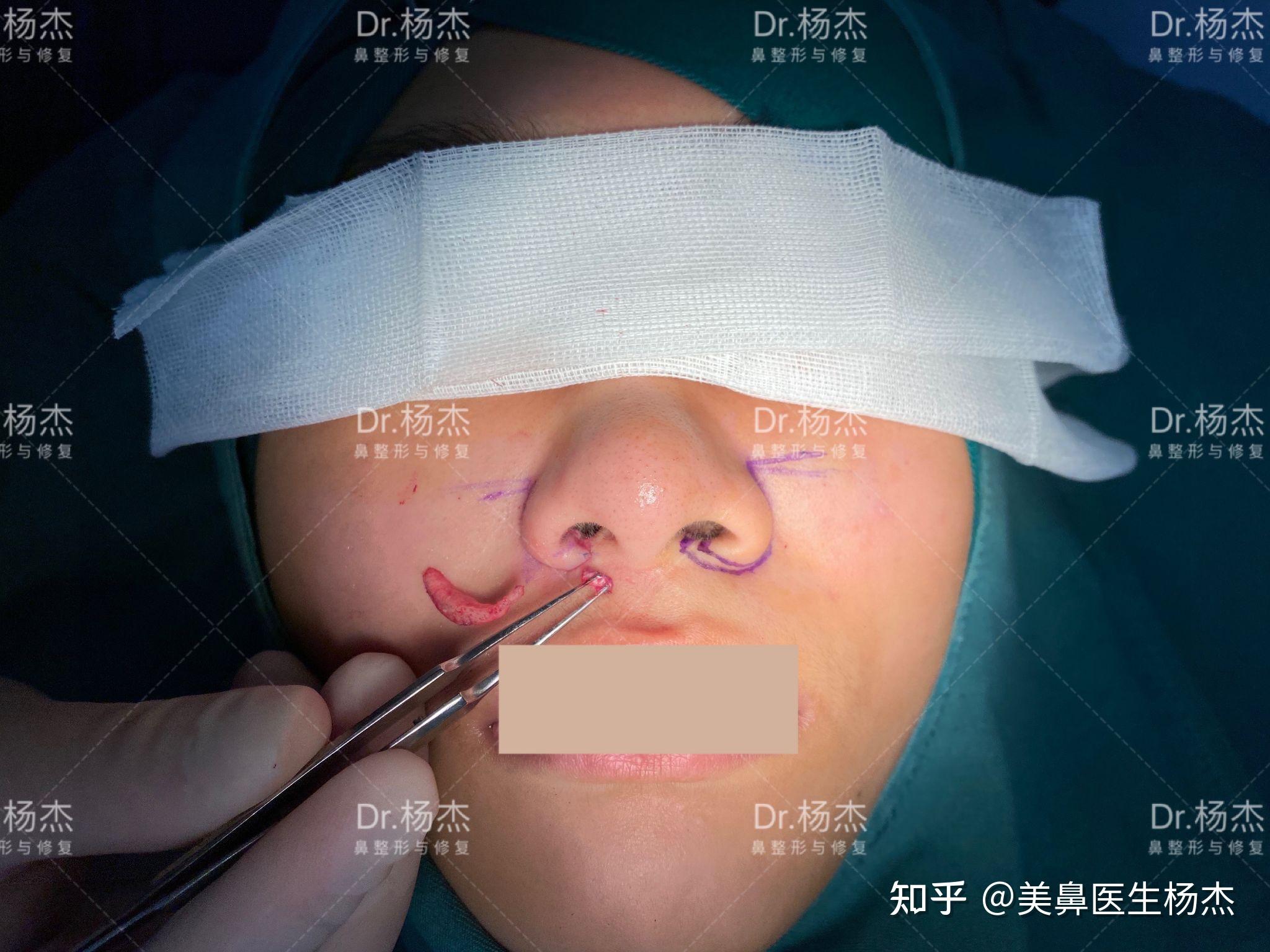 只做了鼻翼外切缩小手术的人对术后效果还满意吗