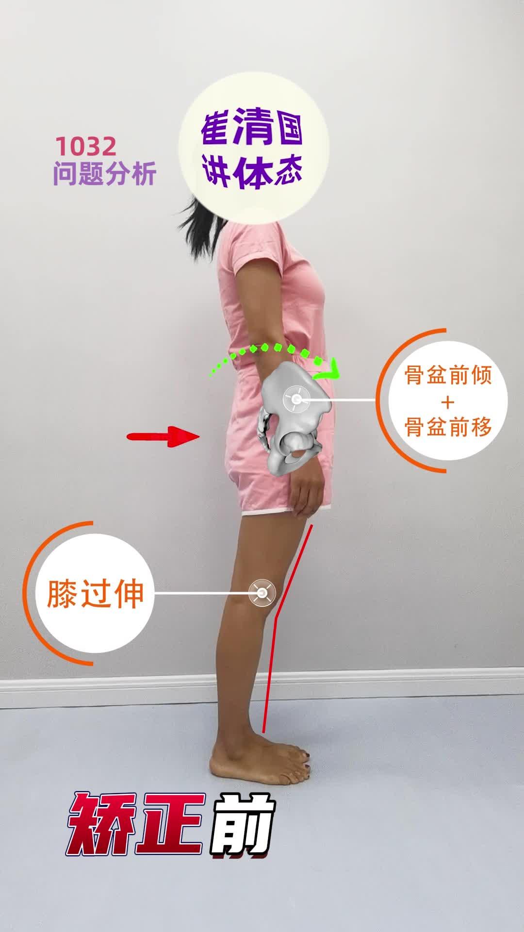 怎么矫正骨盆后倾