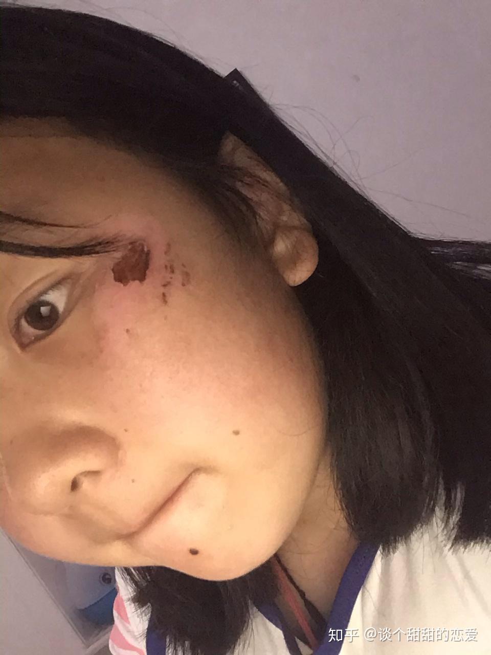 脸部擦伤如图,请问如何恢复? - 知乎