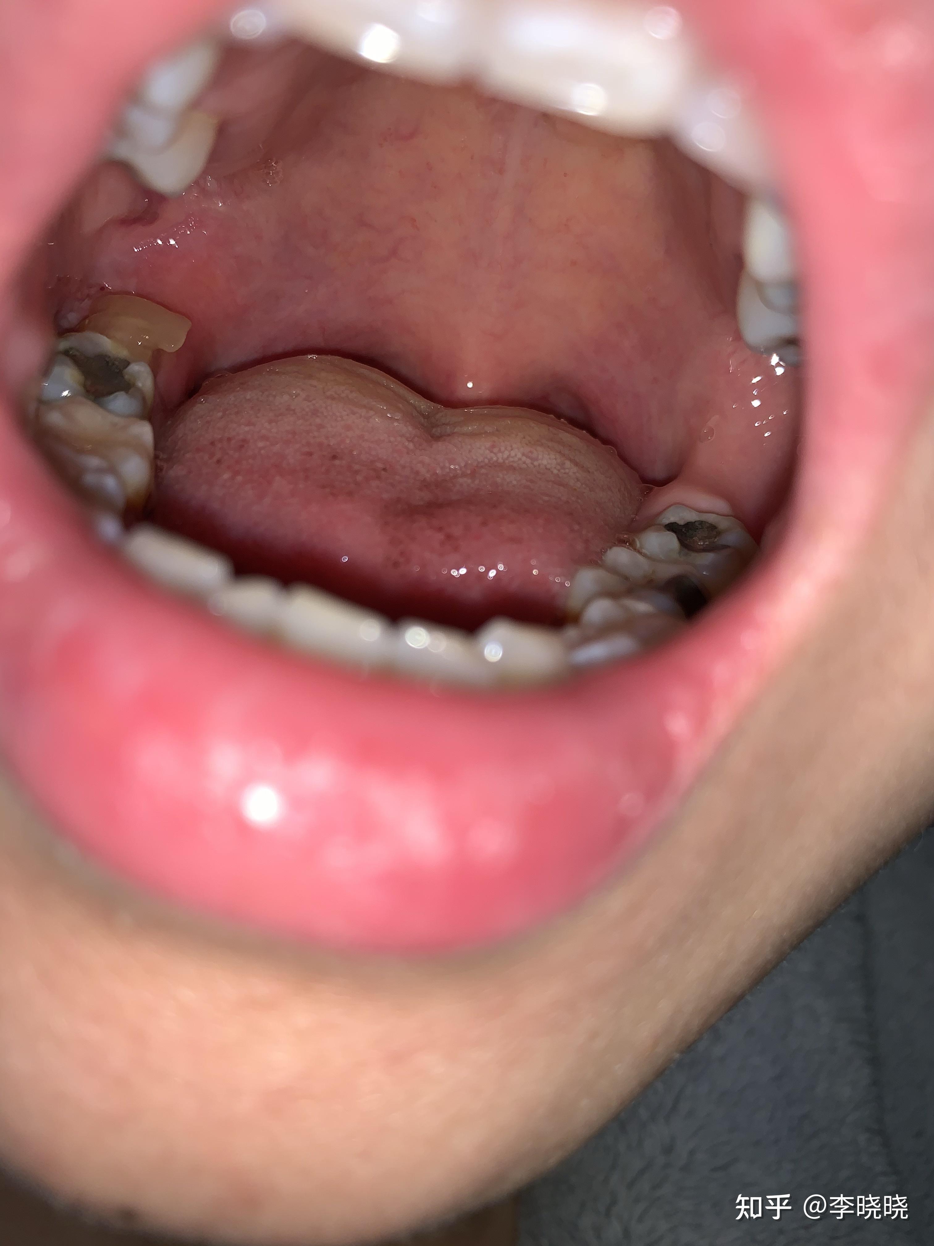 拔牙5天后牙窝愈合过程图图解（拔牙后的"血窟窿"是怎么长好的？了解后再也不用怕拔牙了） | 说明书网