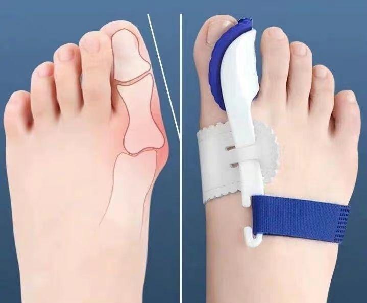 有没有人做过大脚骨(拇指外翻)的手术,效果怎么样?有没有后遗症?